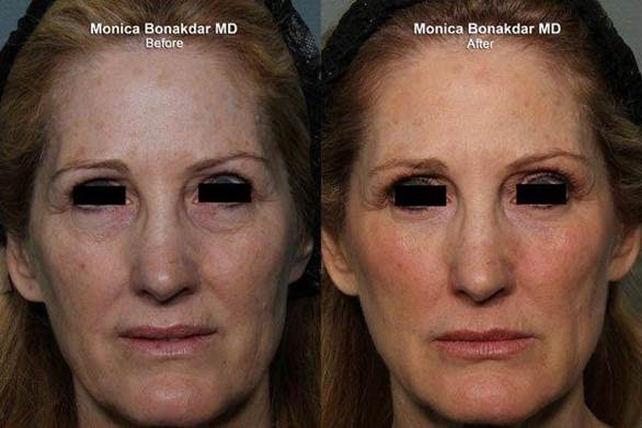 Sunken Eyes Treatment Newport Beach