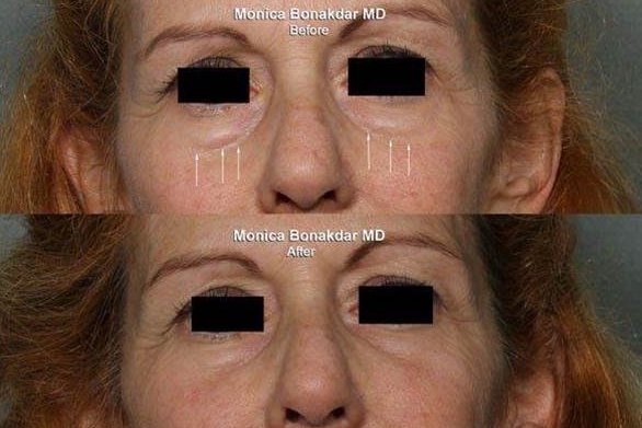 Sunken Eyes Treatment Newport Beach