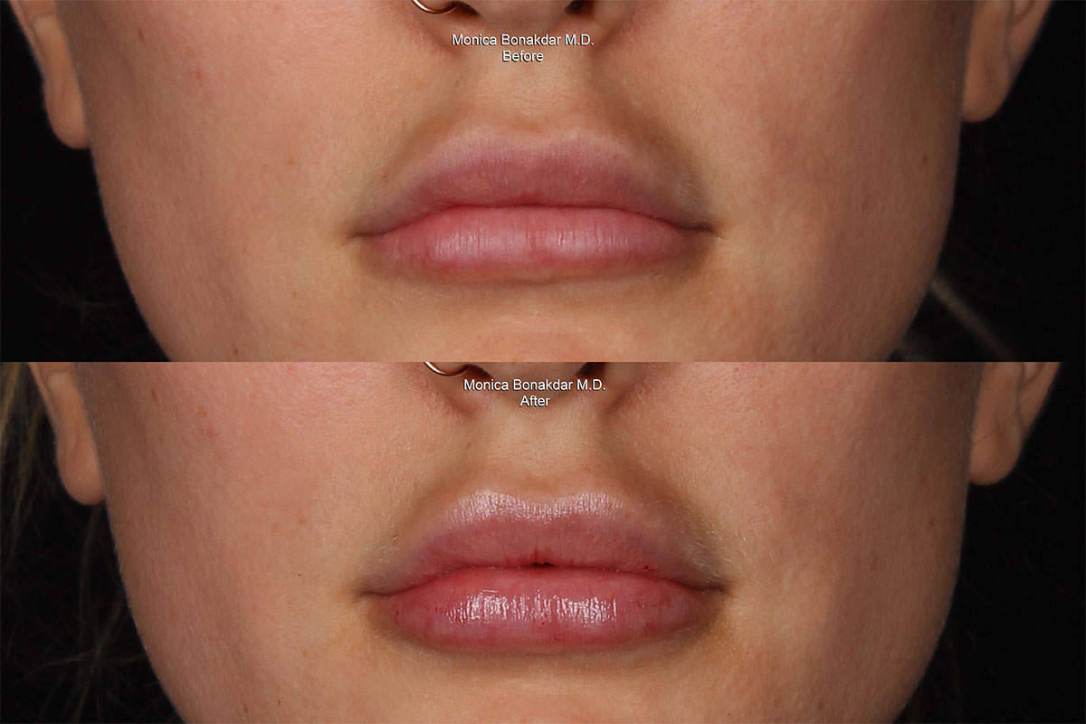 Lip Fillers Newport Beach