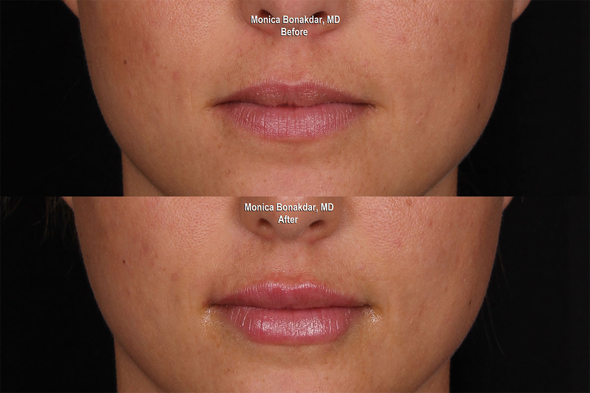 Lip Fillers Newport Beach