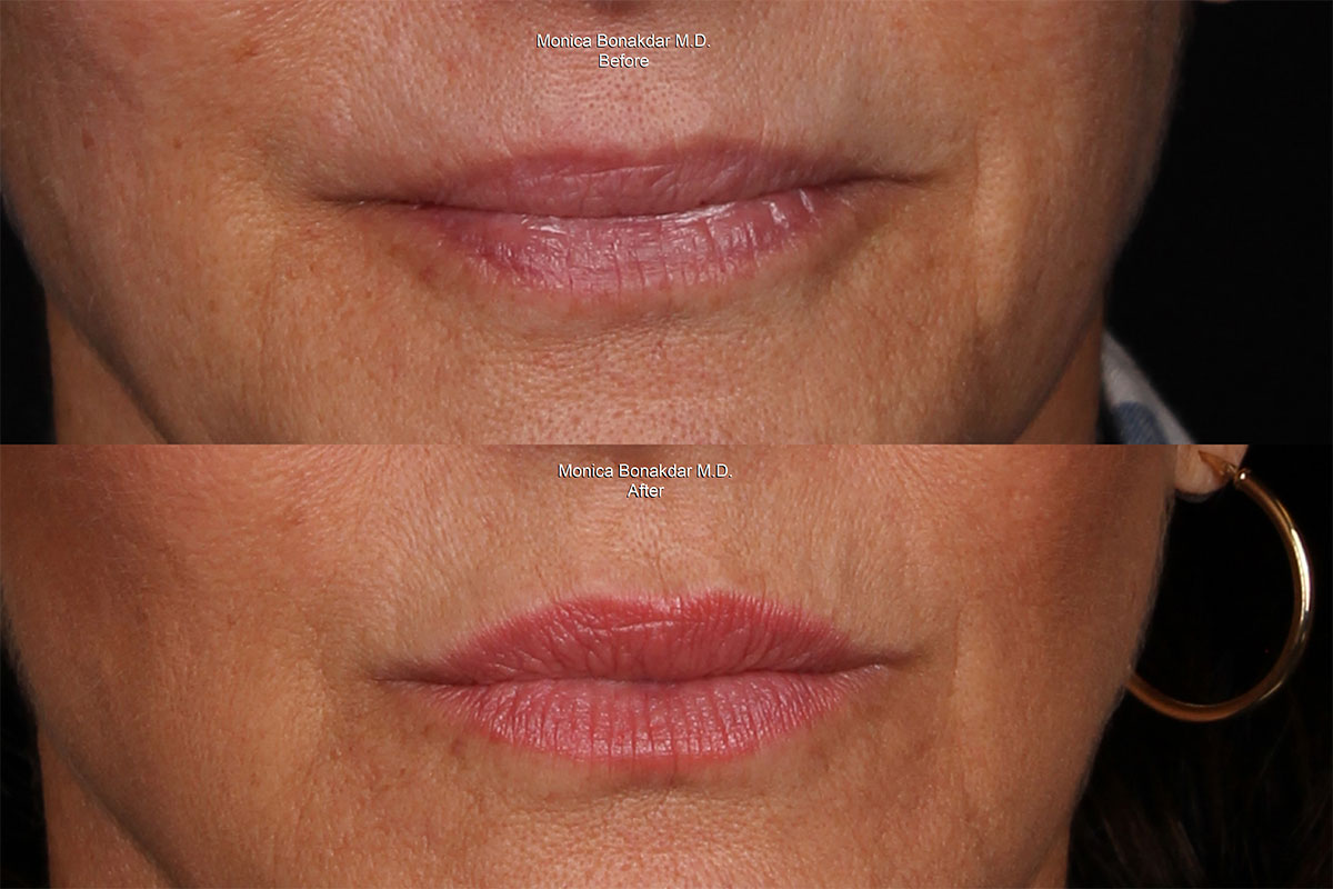 Lip Fillers Newport Beach