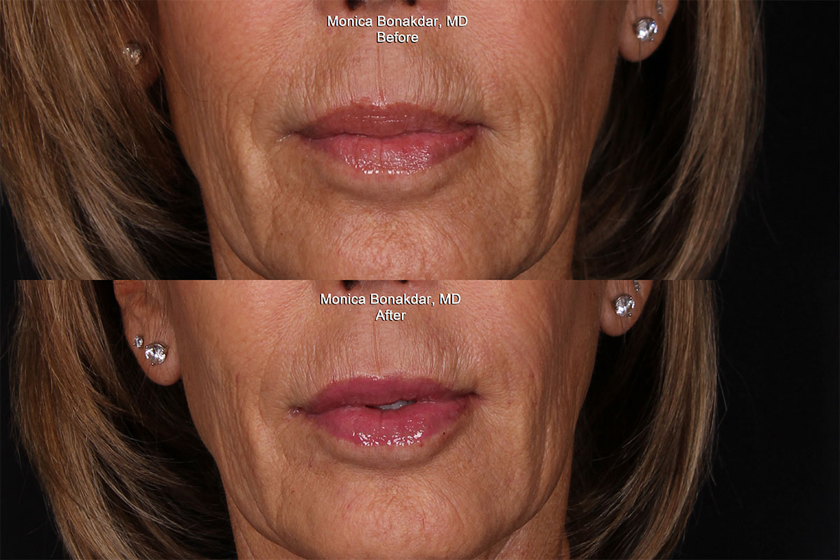 Lip Fillers Newport Beach