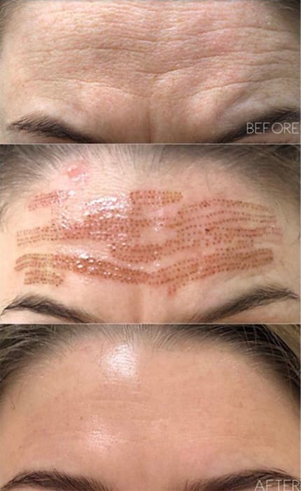 plasma pen before and afters