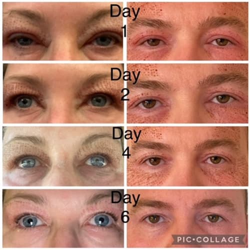 plasma pen before and afters