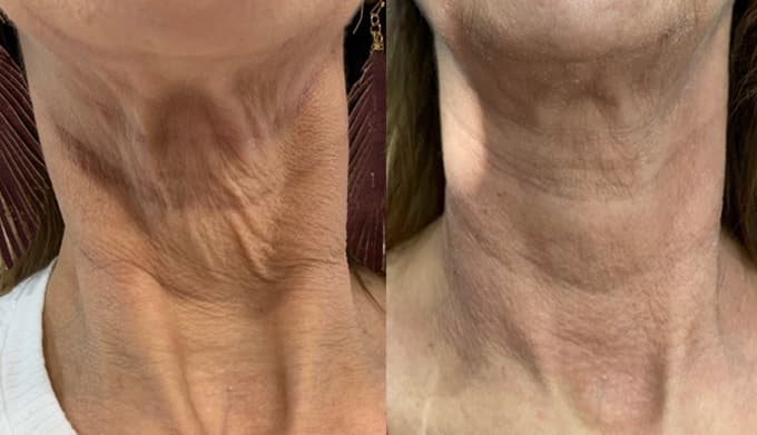 plasma pen before and afters