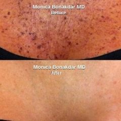 Are your neck and chest summer ready? Dr. Bonakdar discusses her approach to neck and chest rejuvenation
