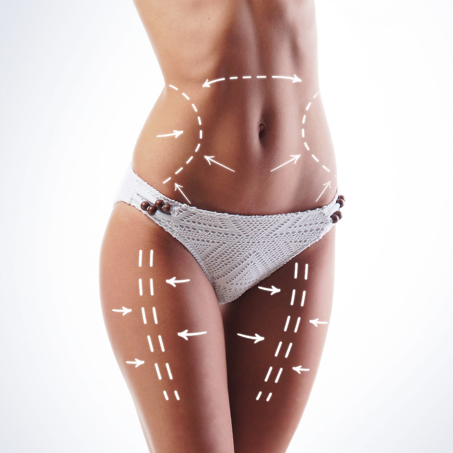 Are there Alternatives to Liposuction Surgery?