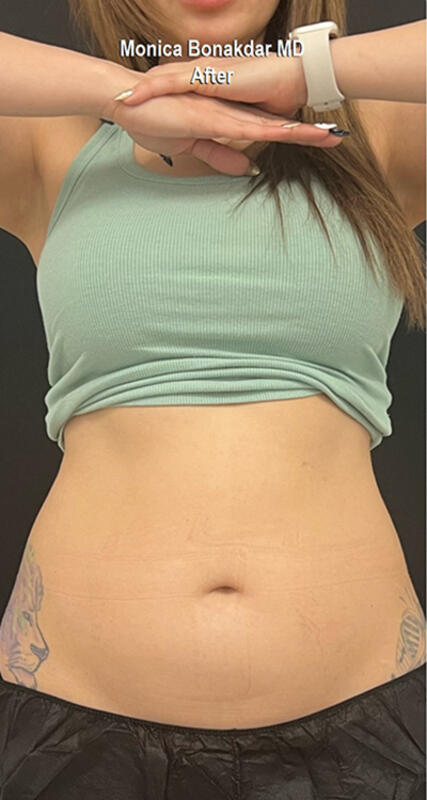 Body Contouring Before & After Photo