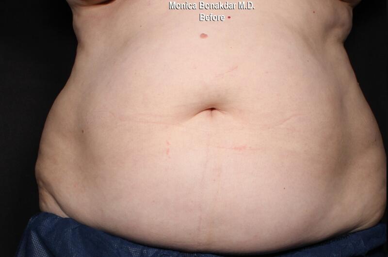 Body Contouring Before & After Photo