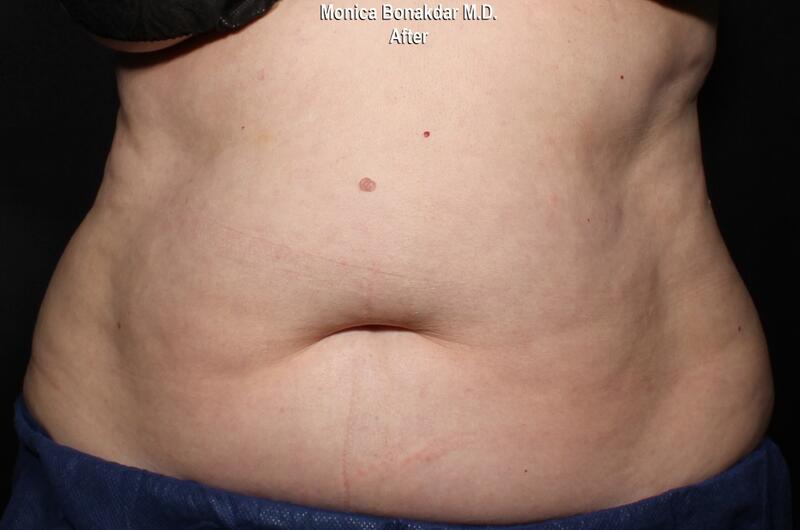 Body Contouring Before & After Photo