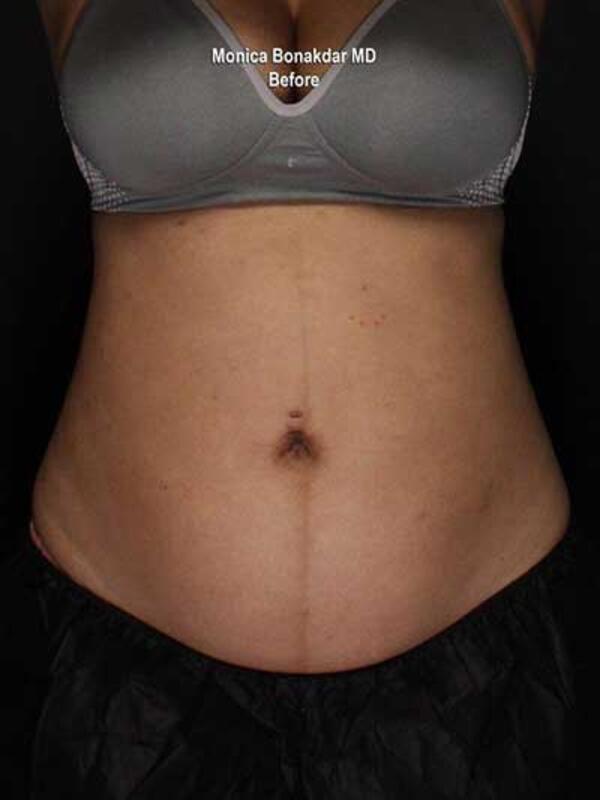 Body Contouring Before & After Photo