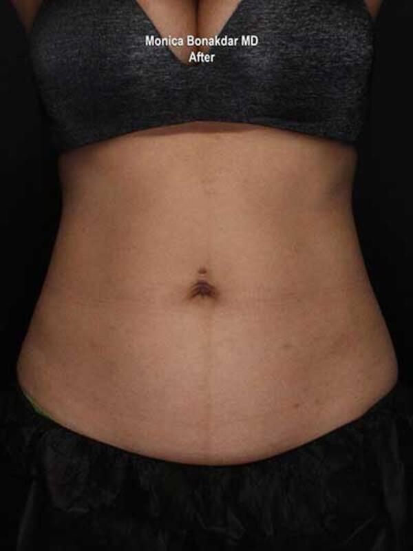 Body Contouring Before & After Photo