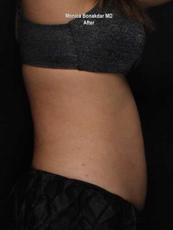 Body Contouring Before & After Photo