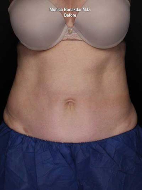 Body Contouring Before & After Photo