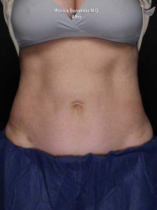 Body Contouring Before & After Photo