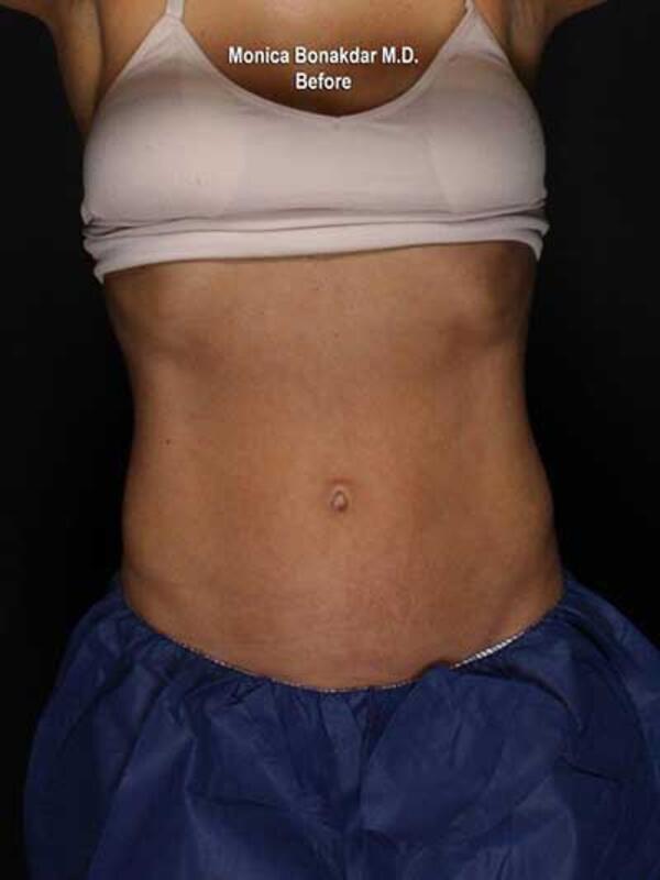 Body Contouring Before & After Photo