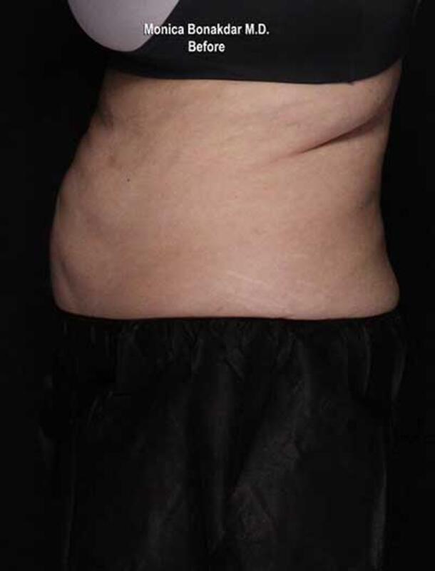 Body Contouring Before & After Photo