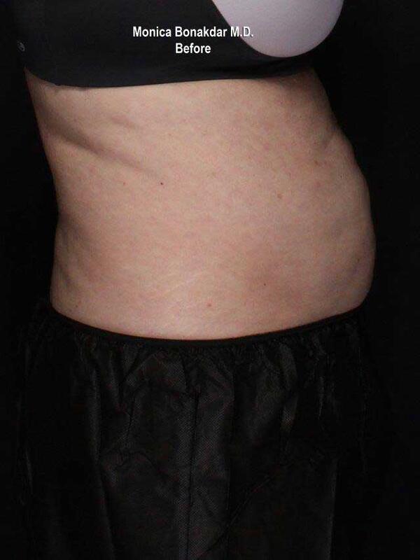 Body Contouring Before & After Photo