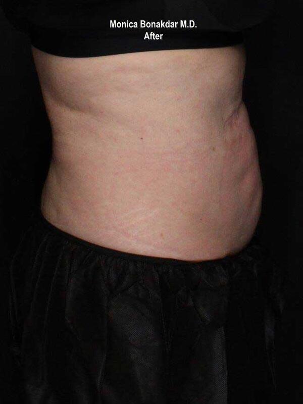 Body Contouring Before & After Photo