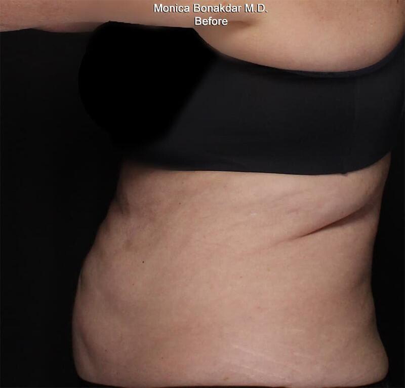 Body Contouring Before & After Photo