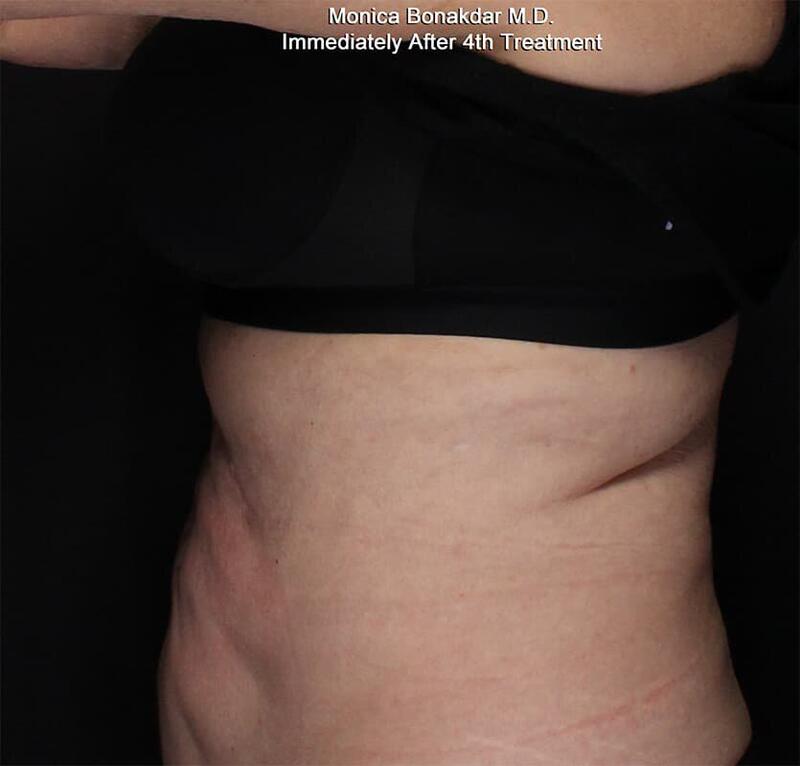 Body Contouring Before & After Photo