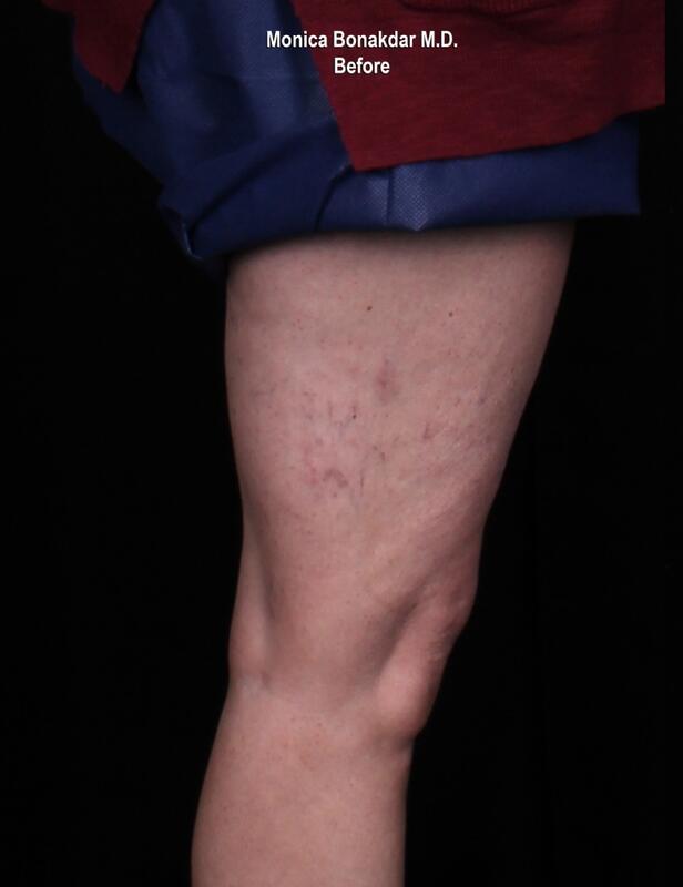 Sclerotherapy Before & After Photo