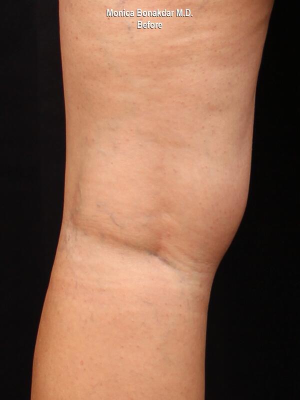 Sclerotherapy Before & After Photo