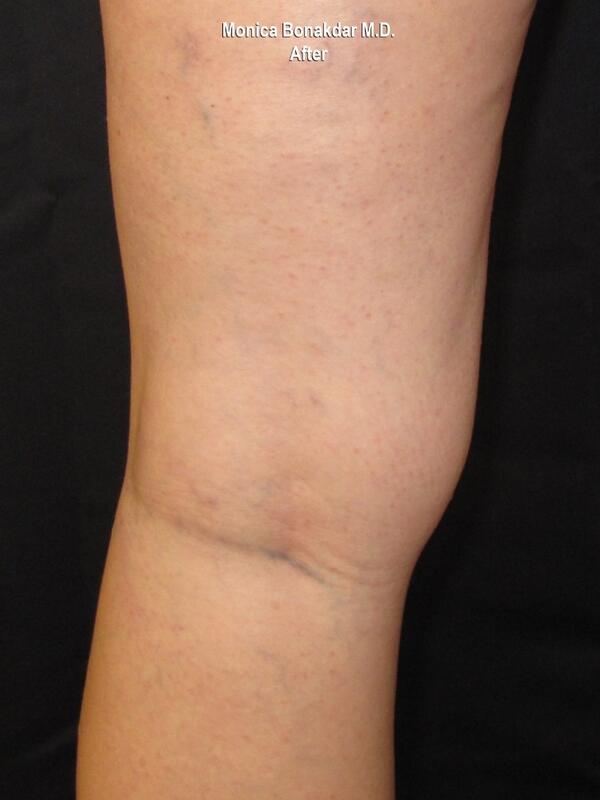 Sclerotherapy Before & After Photo