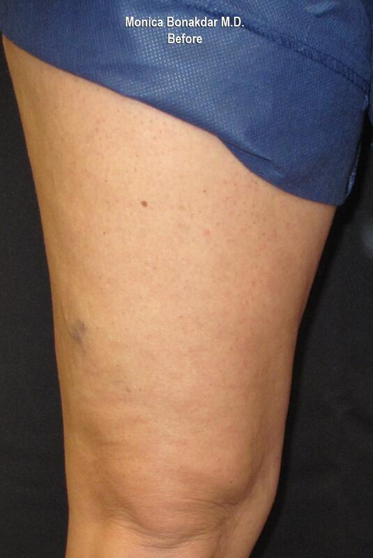 Sclerotherapy Before & After Photo