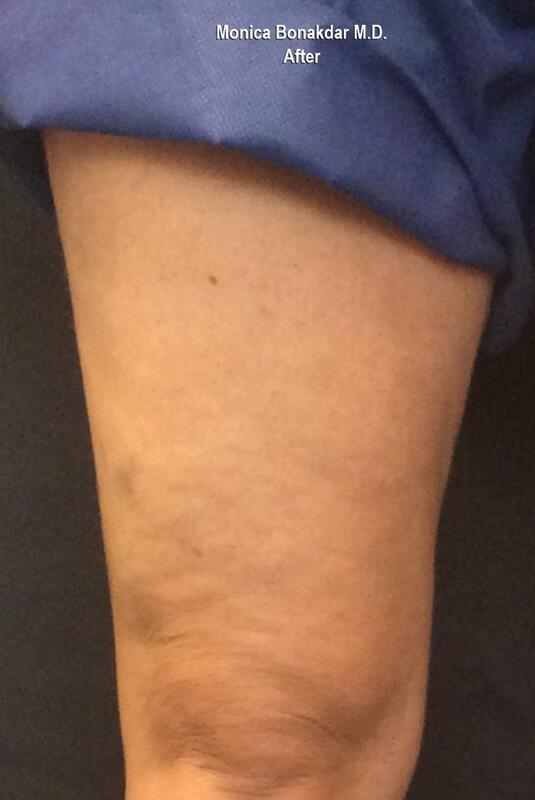 Sclerotherapy Before & After Photo
