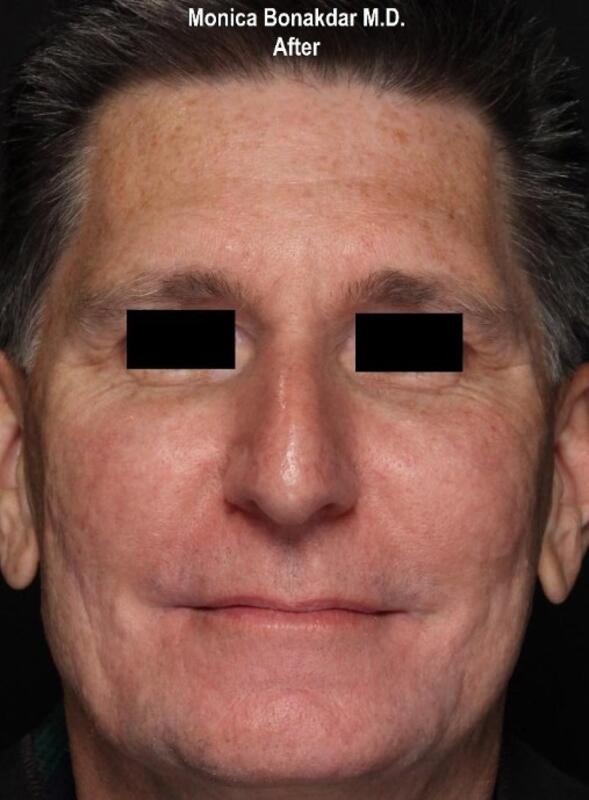 Full Facial Rejuvenation - Male AmpliPhi Before & After Photo