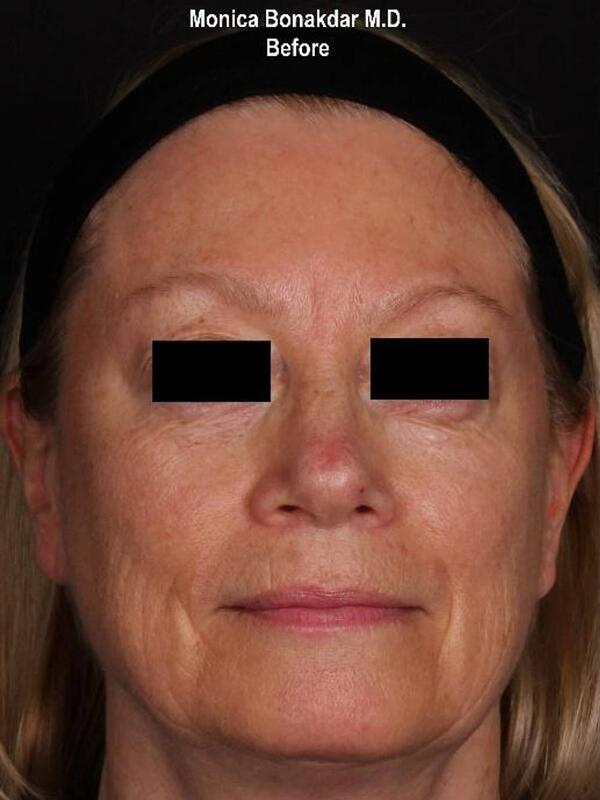 AmpliPHI Full Face Optimization - Women Before & After Photo