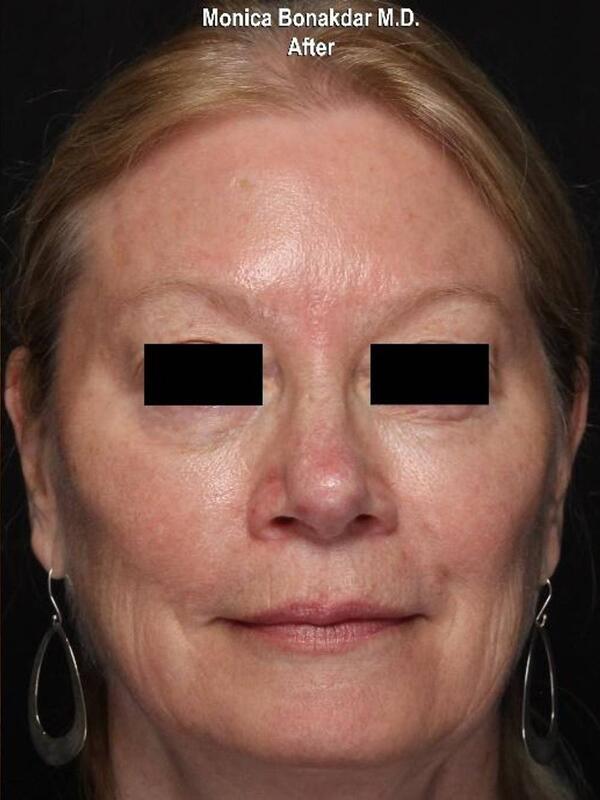 AmpliPHI Full Face Optimization - Women Before & After Photo