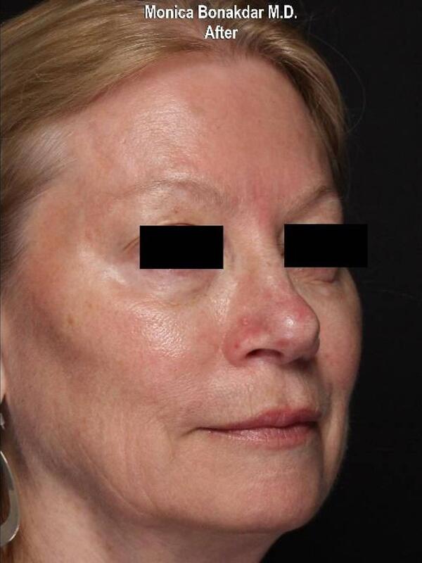 AmpliPHI Full Face Optimization - Women Before & After Photo