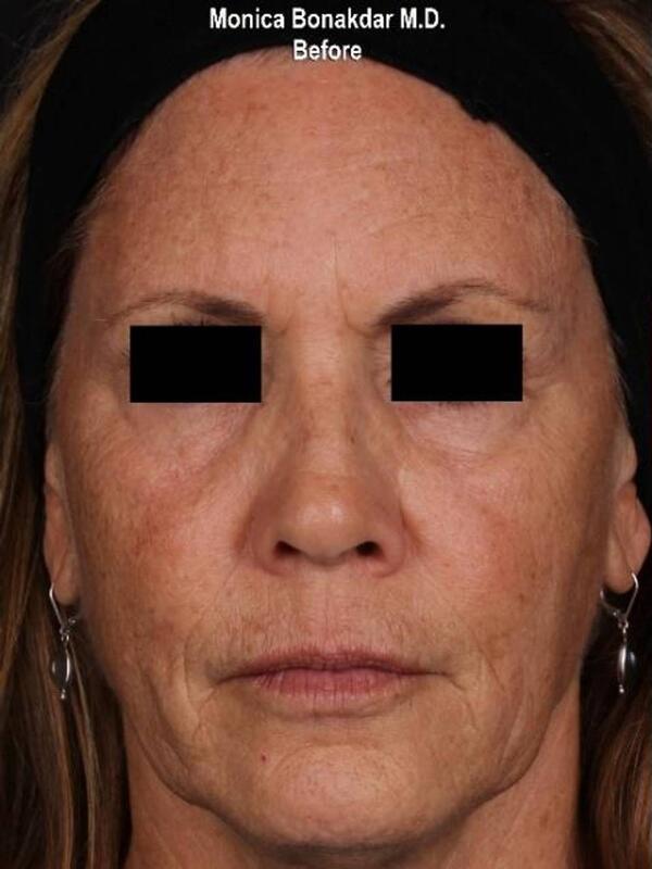 AmpliPHI Full Face Optimization - Women Before & After Photo