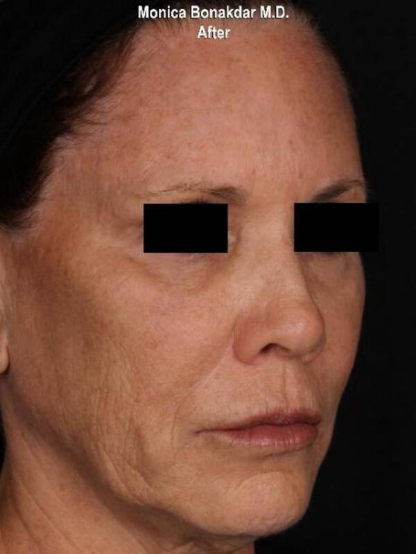 AmpliPHI Full Face Optimization - Women Before & After Photo