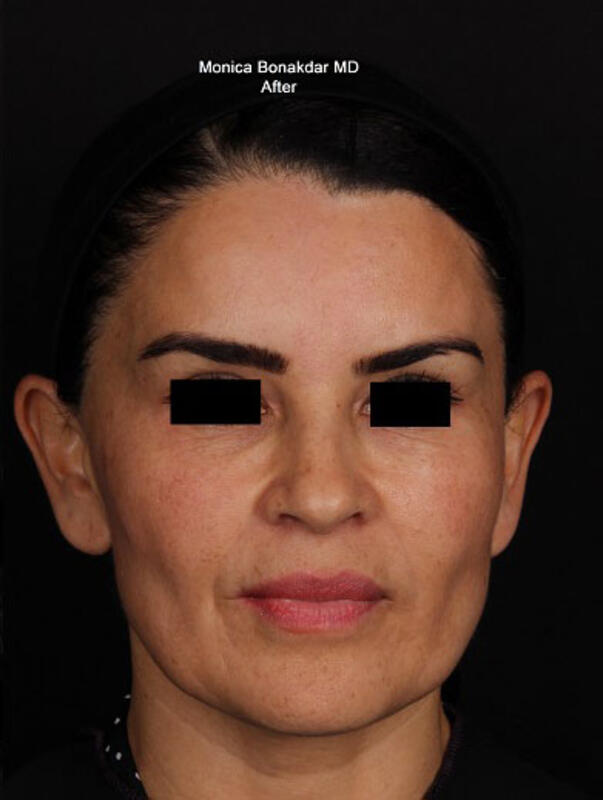 AmpliPHI Full Face Optimization - Women Before & After Photo