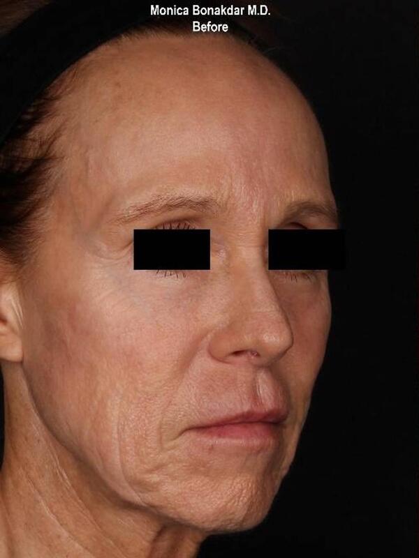 Full Facial Rejuvenation - Female AmpliPhi Before & After Photo