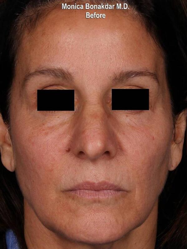 Full Facial Rejuvenation - Female AmpliPhi Before & After Photo