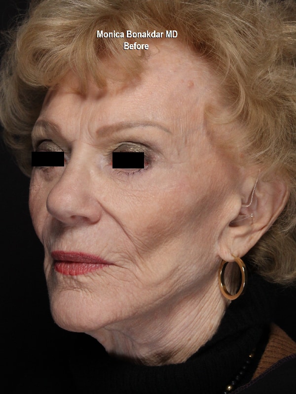 Female AmpliPHI Before & After Photo