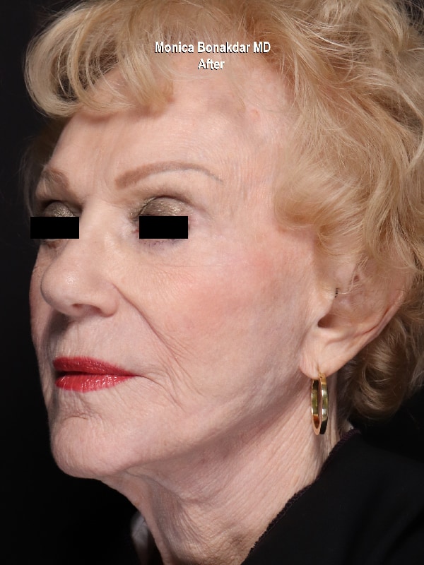 Female AmpliPHI Before & After Photo