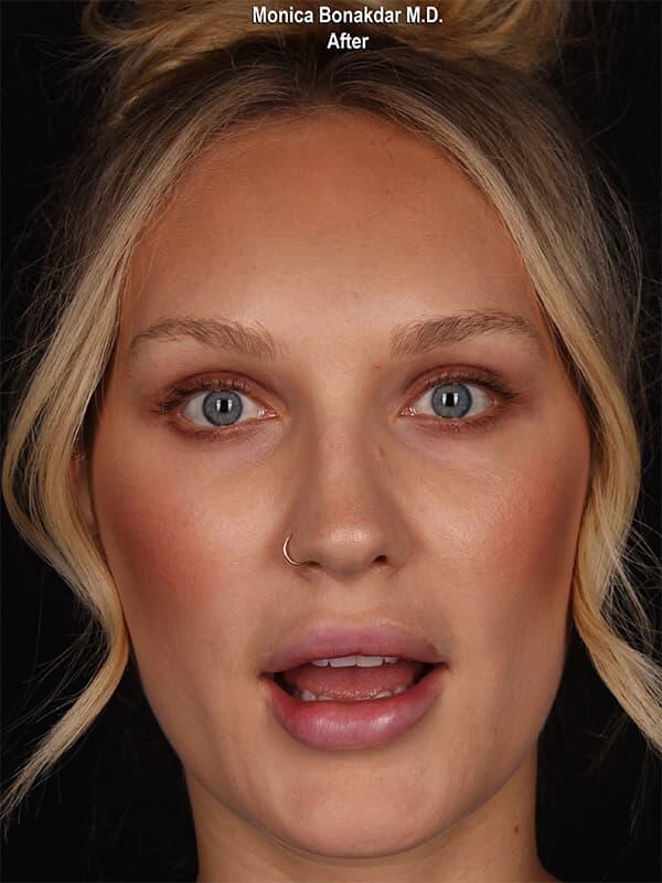 Injectable Treatments Before & After Photo