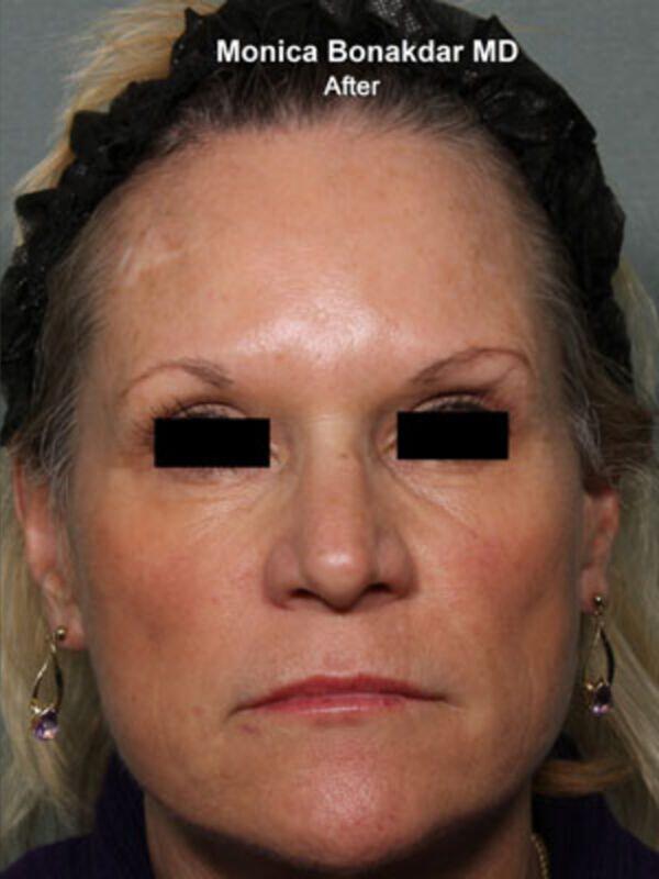 Injectable Treatments Before & After Photo