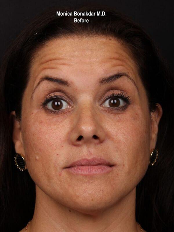Injectable Treatments Before & After Photo