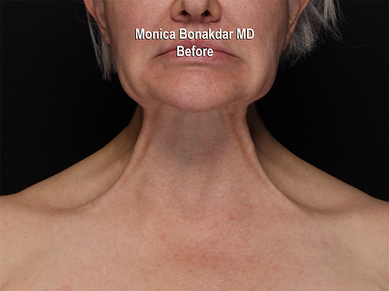 Botox Neck Before & After Photo