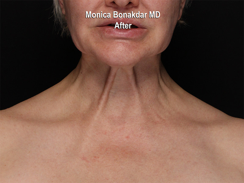 Botox Neck Before & After Photo