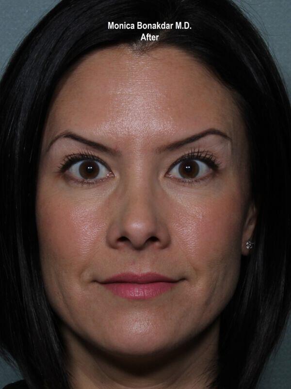 Botox Cosmetic Before & After Photo