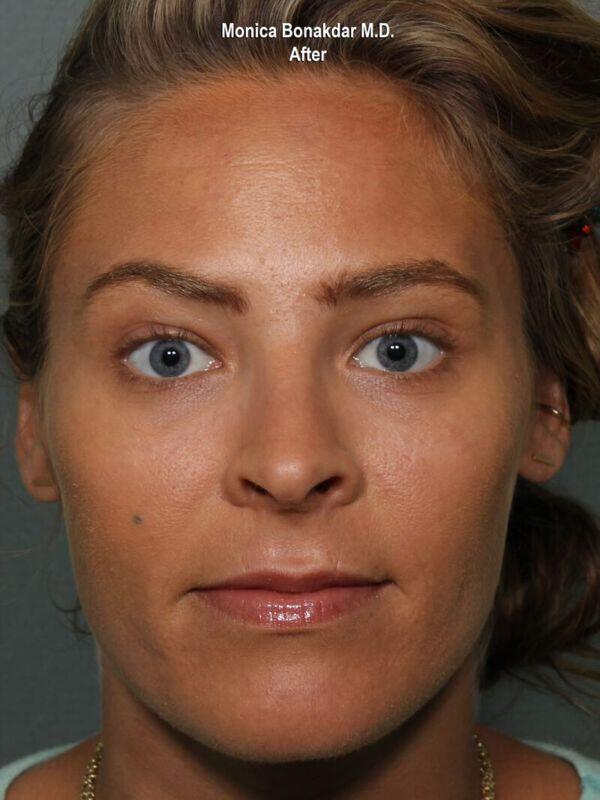 Botox Cosmetic Before & After Photo