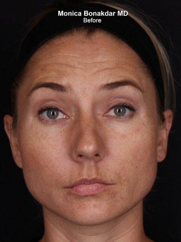 Injectable Treatments Before & After Photo