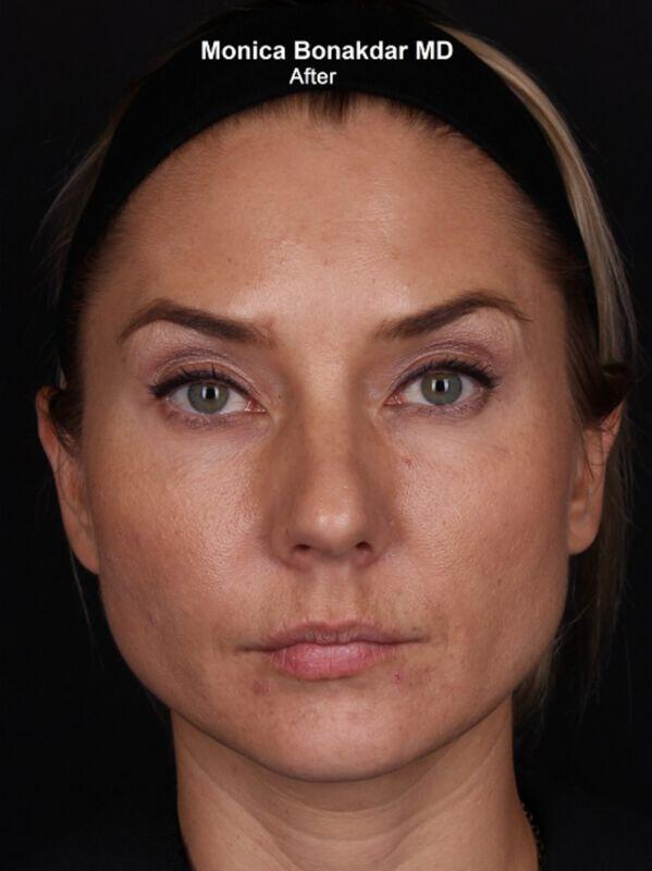Injectable Treatments Before & After Photo
